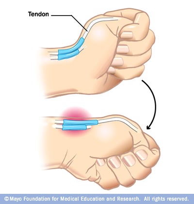 tendon